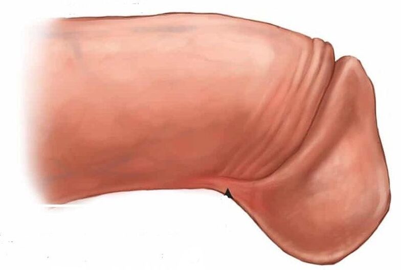 comment agrandir le gland du pénis